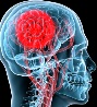 Research into rare dementias receives funding boost